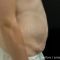 Abdominoplastyka (operacja powłok brzucha)