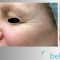 Fotorejuvenizácia /Resurfacing