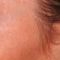 Nichtchirurgische Faltenbehandlung - BOTOX® / DYSPORT®