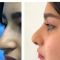Rhinoplastie