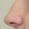 Rinoplastika (operacija nosa)