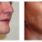 PRP – Plasma therapy