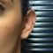 Otoplastie (Chirurgie esthétique des oreilles)