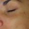 Hydradermabraze