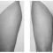 Liposuccion