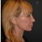 Facelift, SMAS facelifting