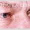 Eyelid surgery (Blepharoplasty)