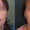 Ear surgery (Otoplasty)