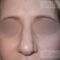 Operácia nosa (Rhinoplastika)