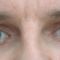 Operácia očných viečok (Blepharoplastika)