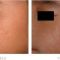 Laser Scar Treatment