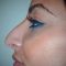 Rhinoplastie Ultrasonique