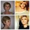 Lifting du visage