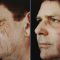 Fractional Laser Resurfacing