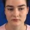 Lip augmentation - cheiloplasty