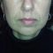 Facelift, SMAS facelifting