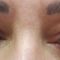 Operácia očných viečok (Blepharoplastika)