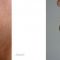 Génioplastie - Chirurgie esthétique du menton