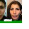 Rhinoplastie