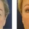 Eyelid surgery (Blepharoplasty)
