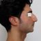 Operácia nosa (Rhinoplastika)