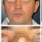 Rhinoplastie secondaire