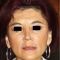 Facelift, SMAS Facelift