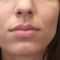 Lip augmentation - cheiloplasty