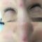 Spider veins laser removal (redness, birh marks)