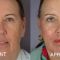 Lifting du visage