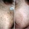 Tattoo removal