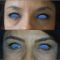 Blépharoplastie