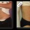 Abdominoplasty (Tummy Tucks)