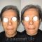 Lifting du visage
