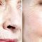 Rádiofrekvenčná rejuvenácia(Aluma, accent, TriPollar, Spa RF, Re-Age)