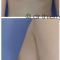 Lipofilling mammaire