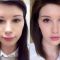 Lip Lift