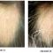 Haarausfall Therapie