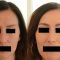 Facelift - 3D kanylové nitě