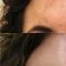 Procedure laser in dermatologia estetica