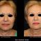 Fotoringiovanimento - resurfacing