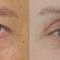Korekcja brwi (Brow lift)