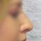 Operácia nosa (Rhinoplastika)