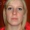 Plastische Kinnoperationen