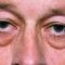 Eyelid surgery (Blepharoplasty)