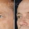 Eyelid surgery (Blepharoplasty)