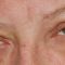 Eyelid surgery (Blepharoplasty)
