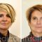 Liquid facelift