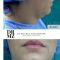 Liposuccion
