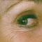 Dermal fillers